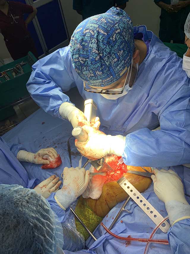 Cemented Bipolar Hemiarthroplasty