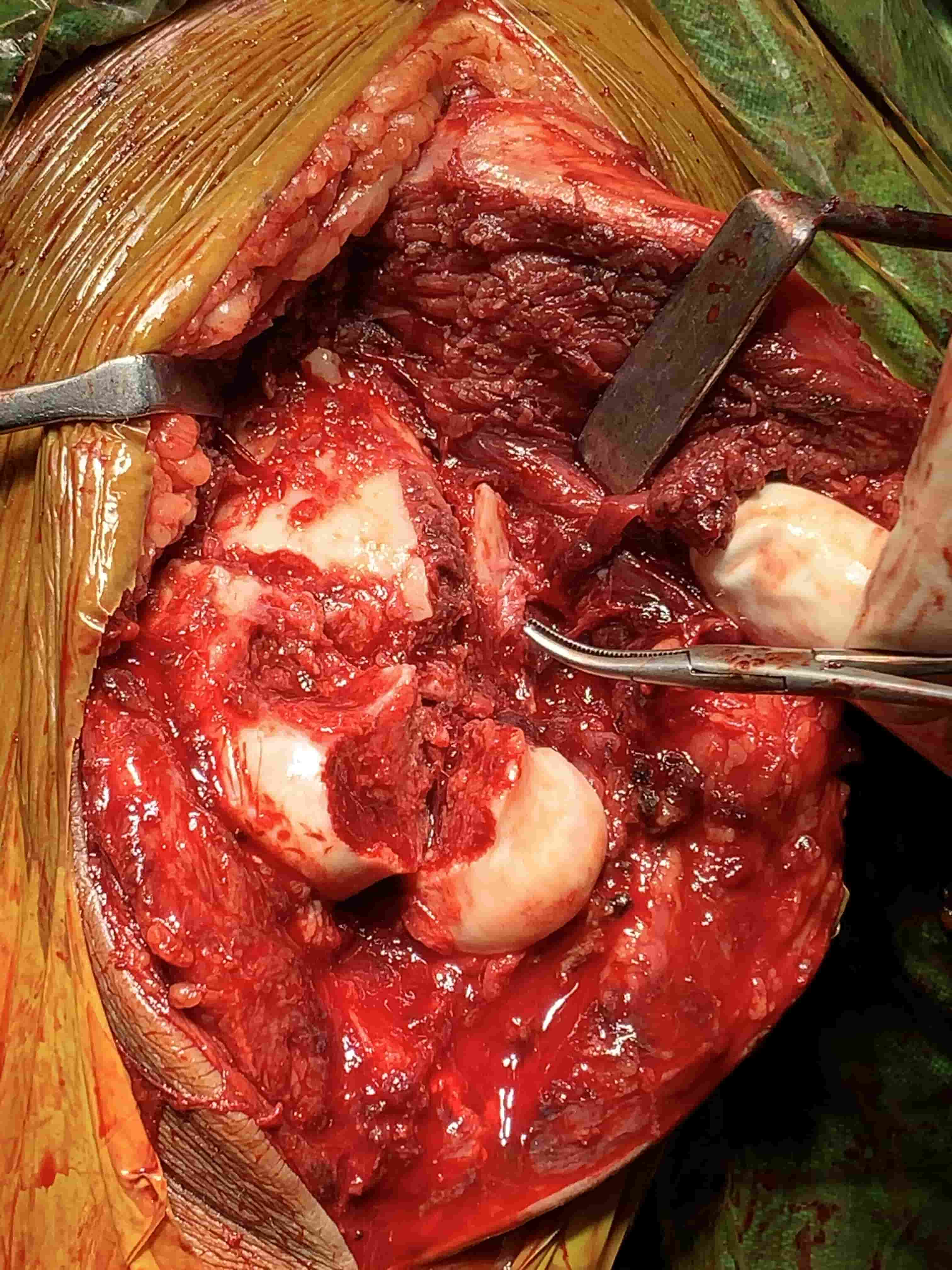 Complex Distal Humerus Comminuted Fracture