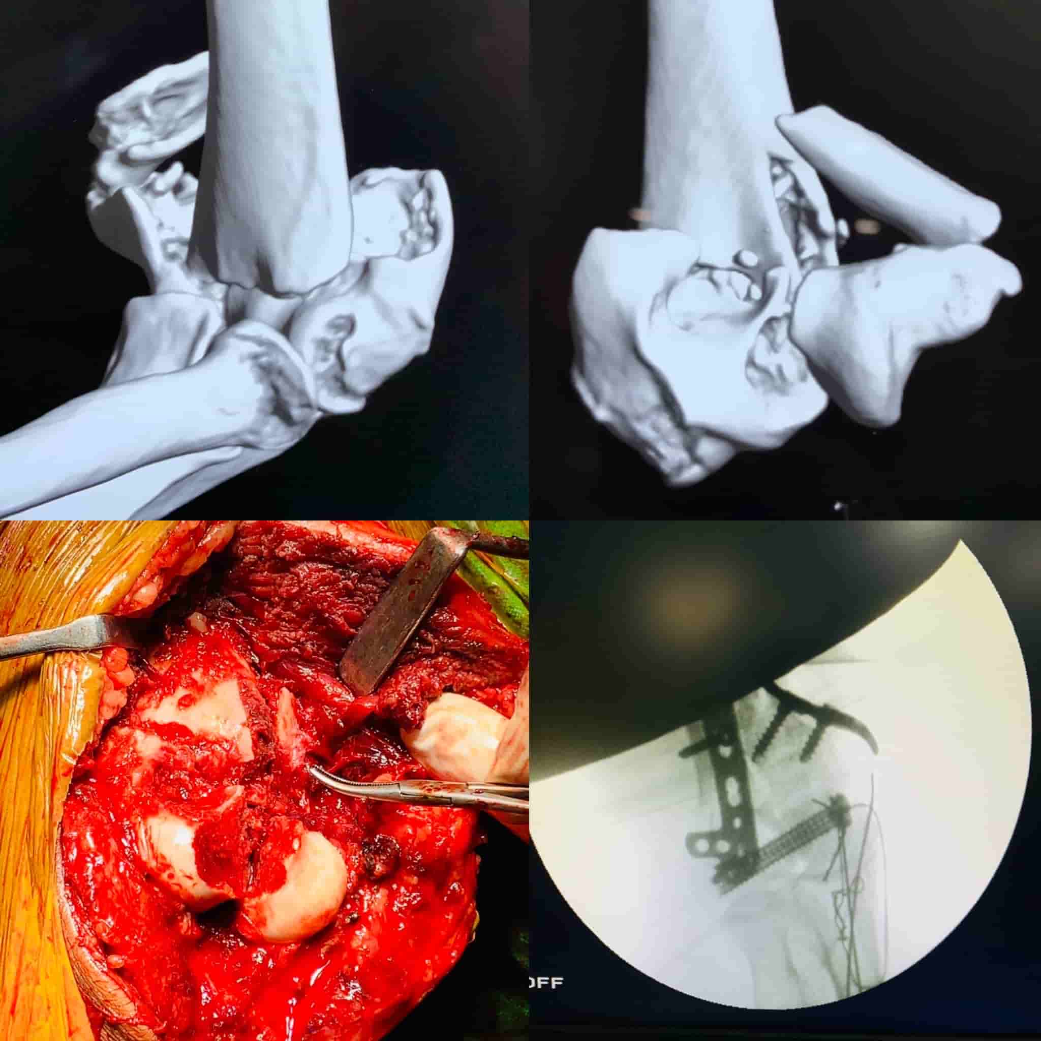Complex Distal Humerus Comminuted Fracture