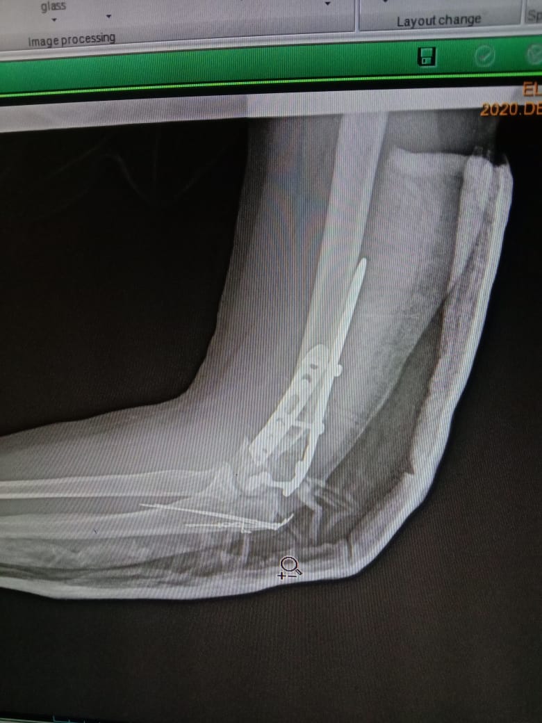 Complex Distal Humerus Comminuted Fracture