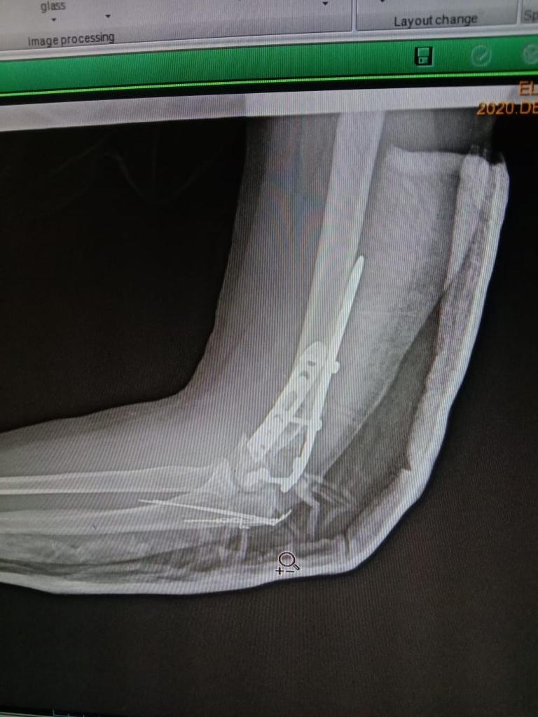 Complex Distal Humerus Comminuted Fracture
