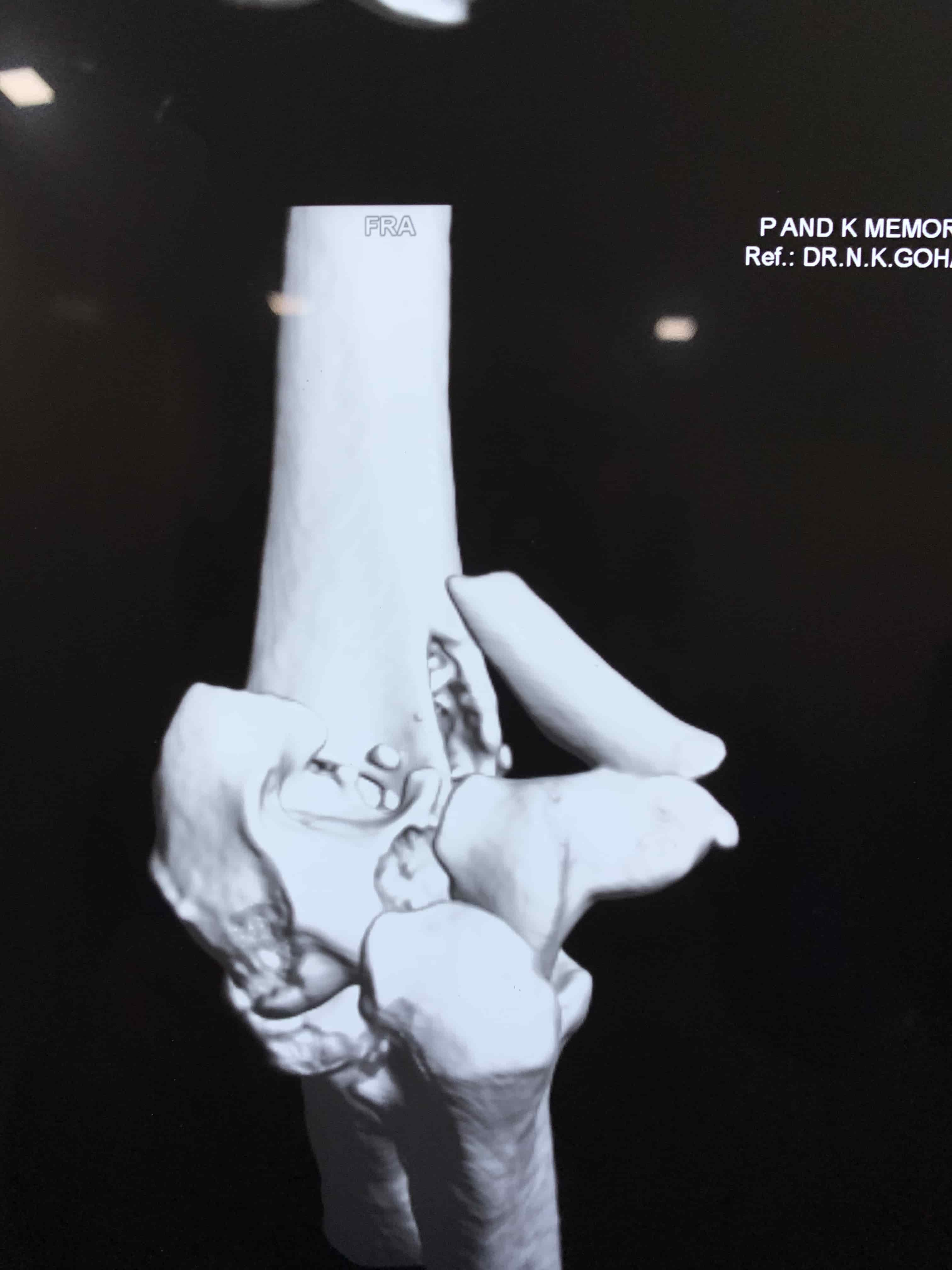Complex Distal Humerus Comminuted Fracture