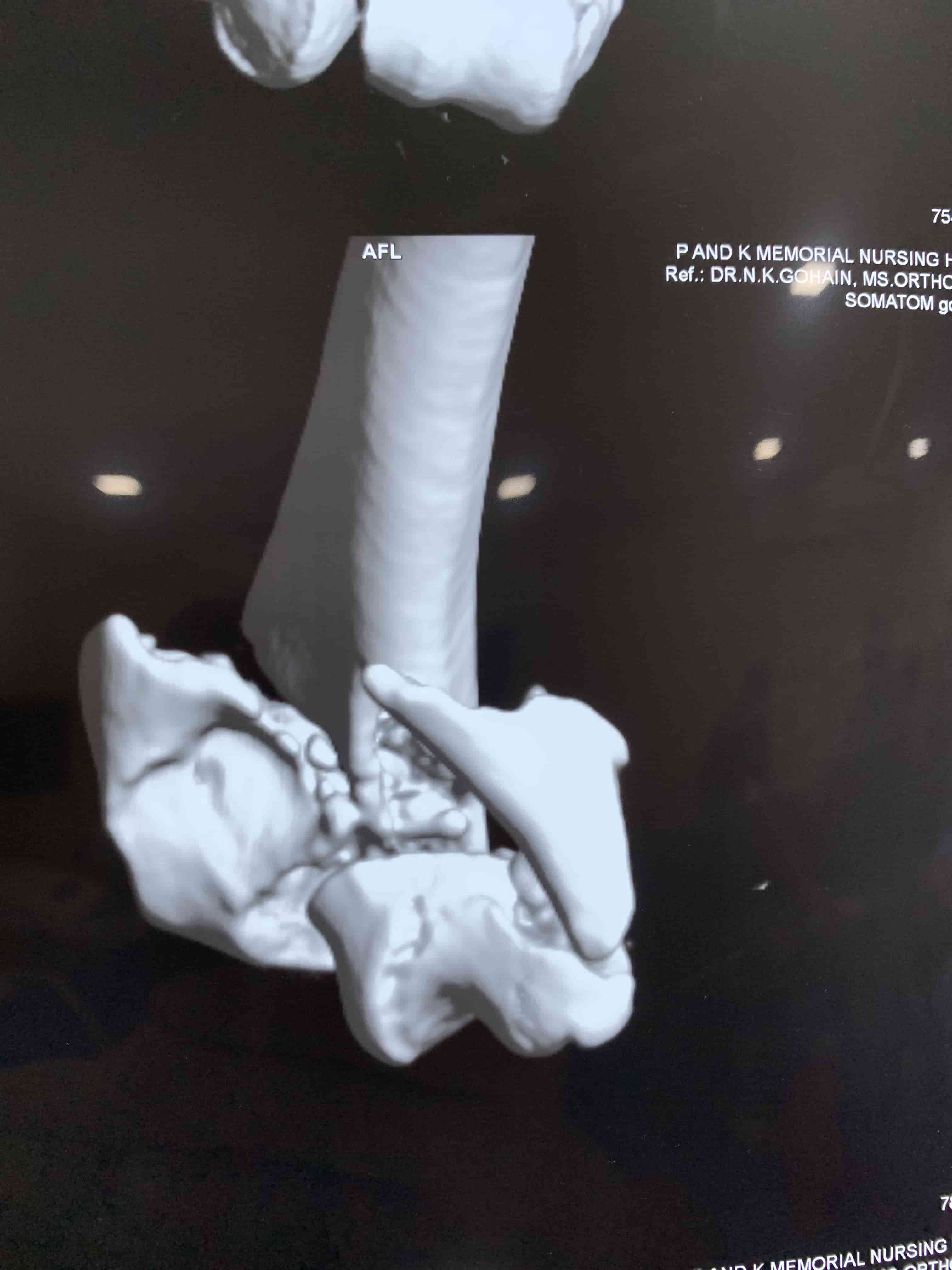Complex Distal Humerus Comminuted Fracture