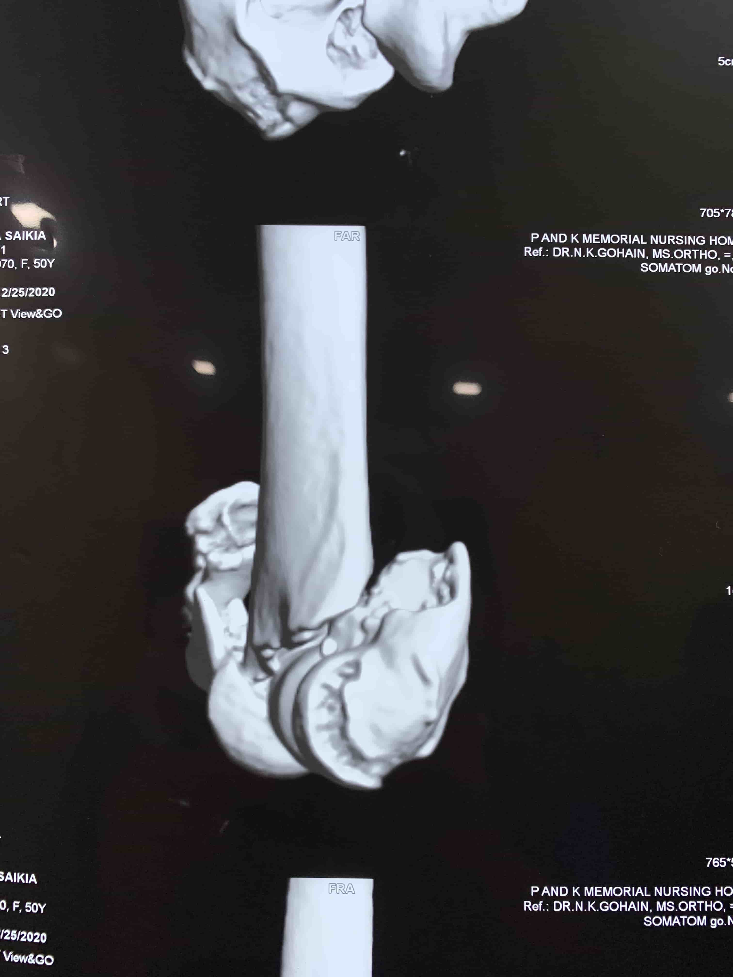 Complex Distal Humerus Comminuted Fracture