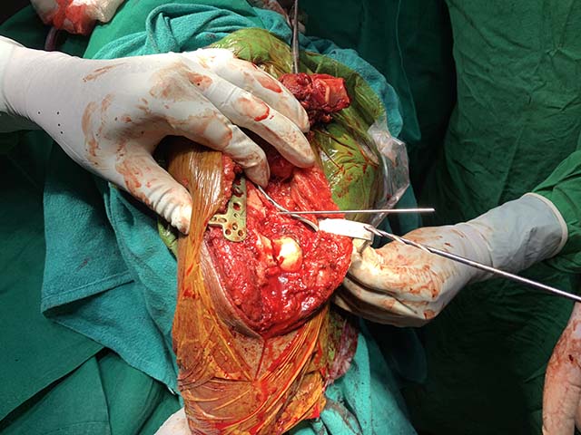 Complex Distal Humerus Comminuted Fracture