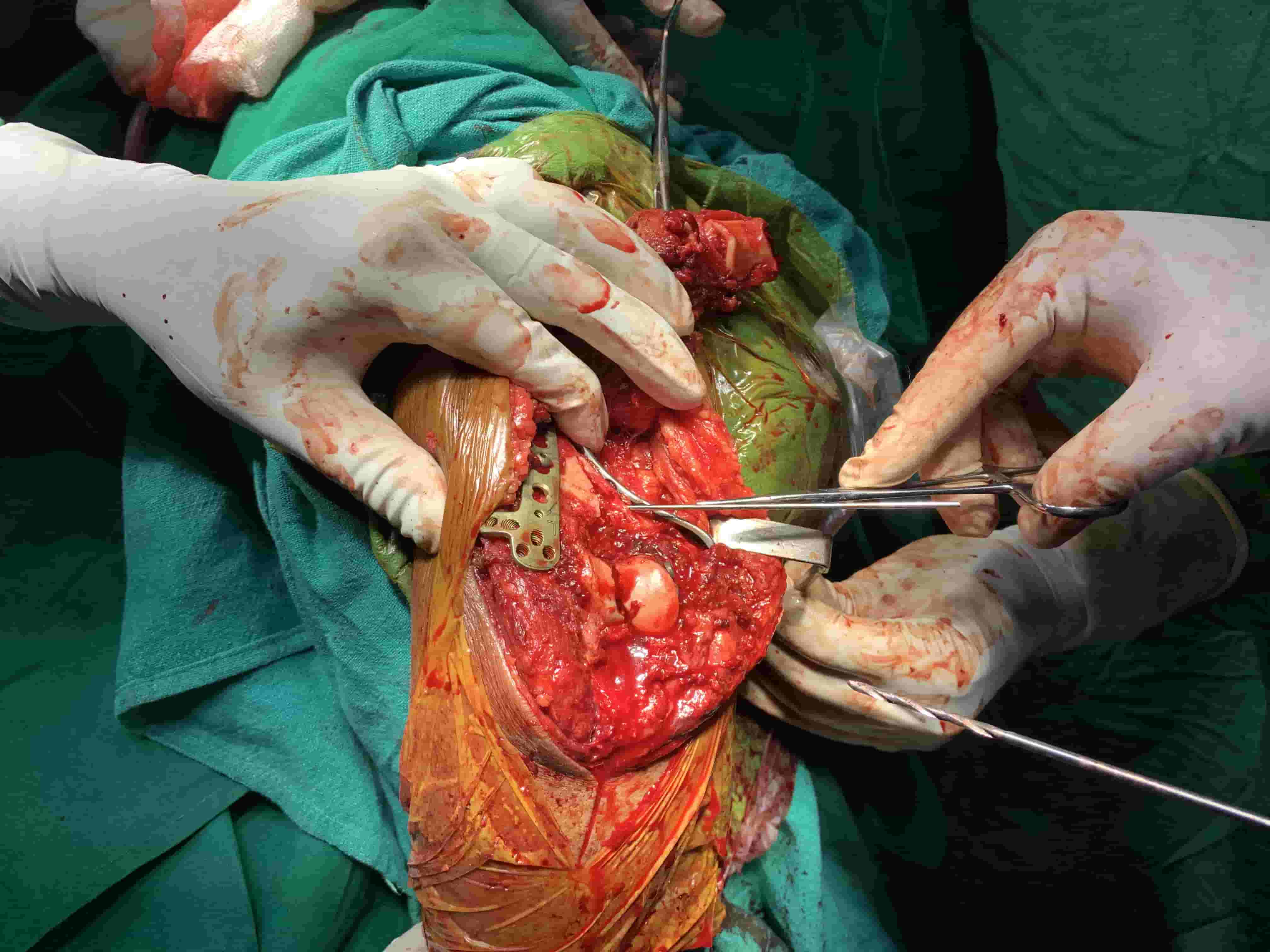Complex Distal Humerus Comminuted Fracture