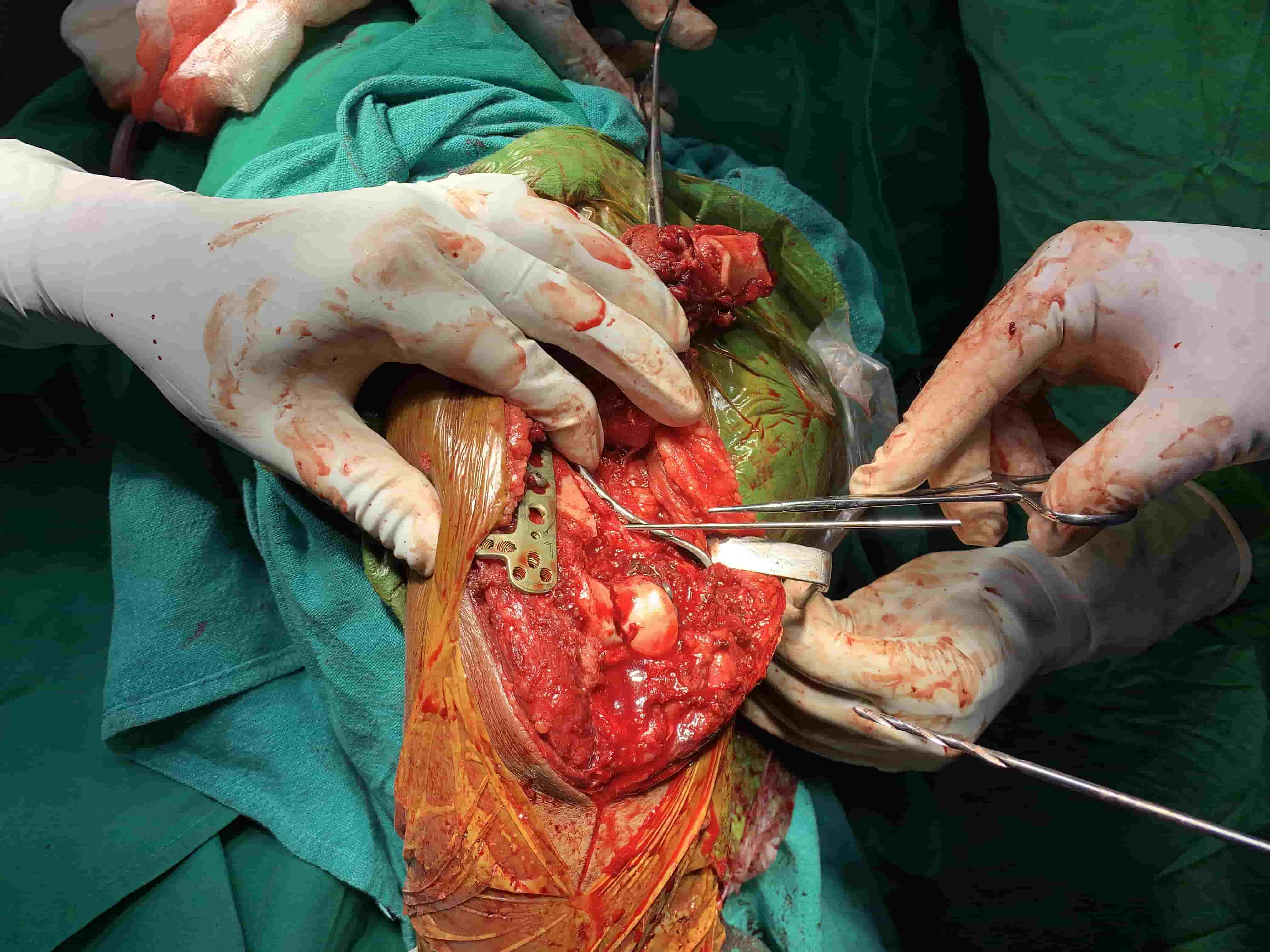 Complex Distal Humerus Comminuted Fracture