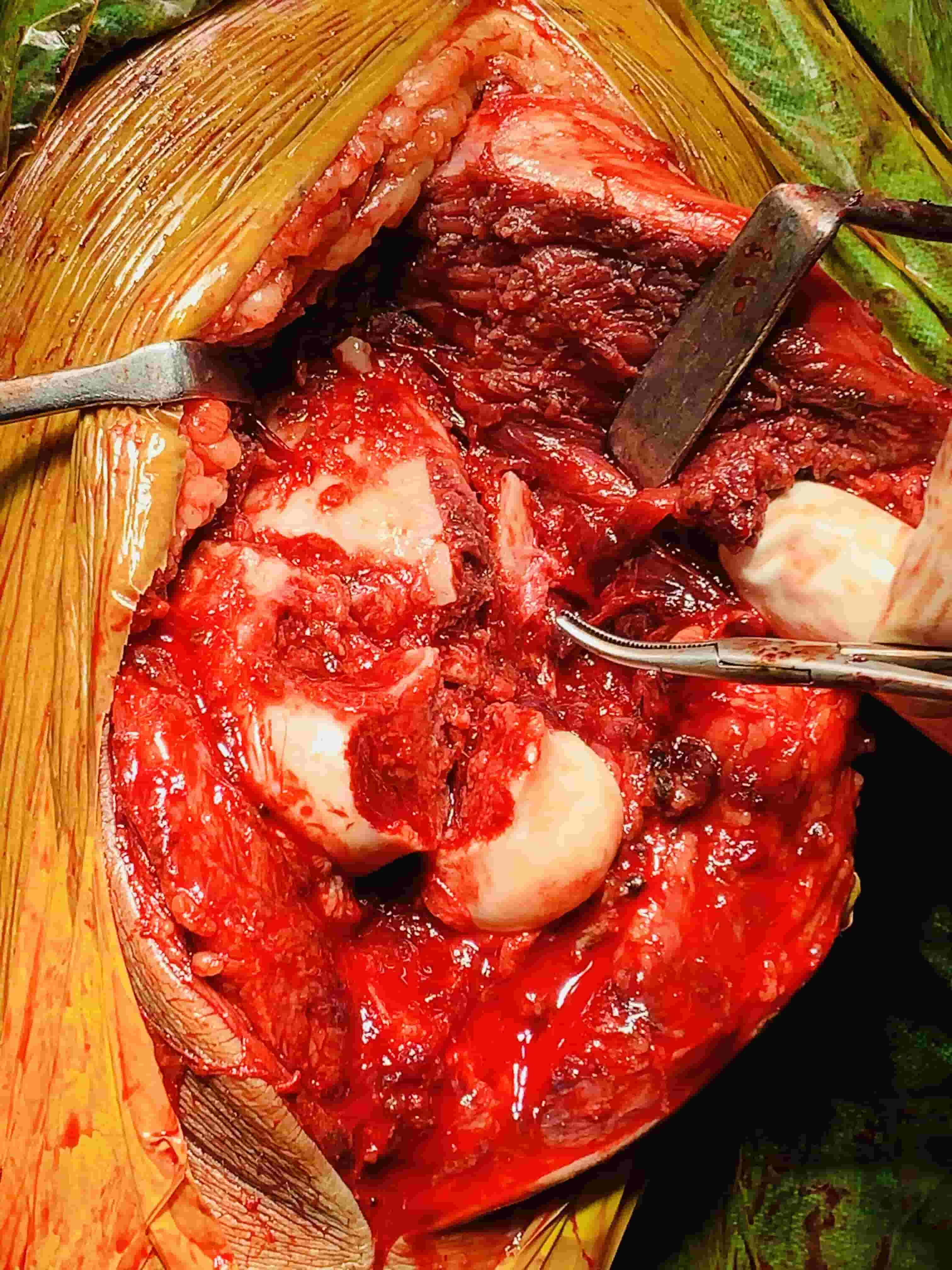 Complex Distal Humerus Comminuted Fracture