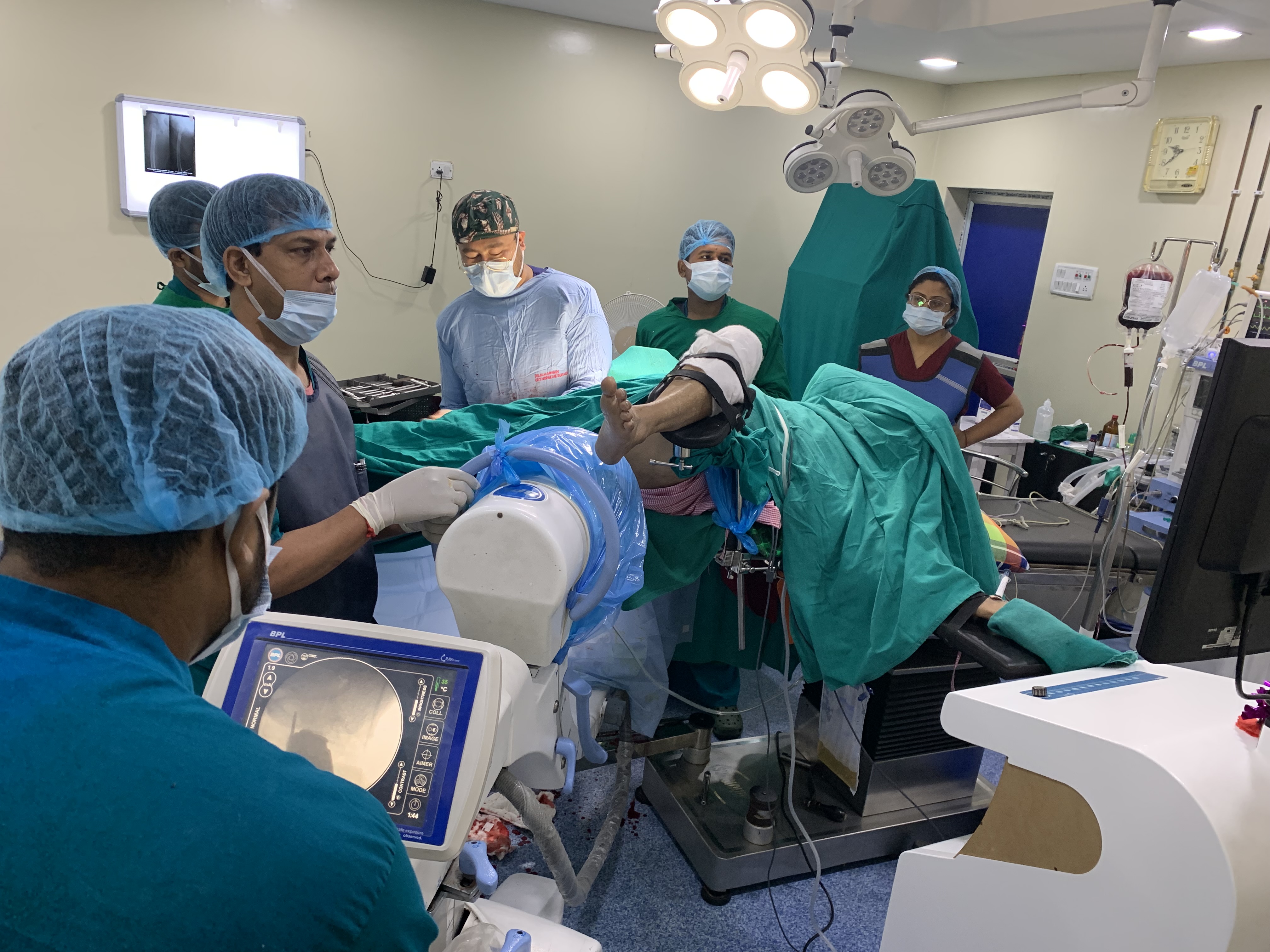 Intertrochanteric femur comminuted fracture treated by Closed Reduction & Internal Fixation with PFNA2 Titanium Interlocking Nail