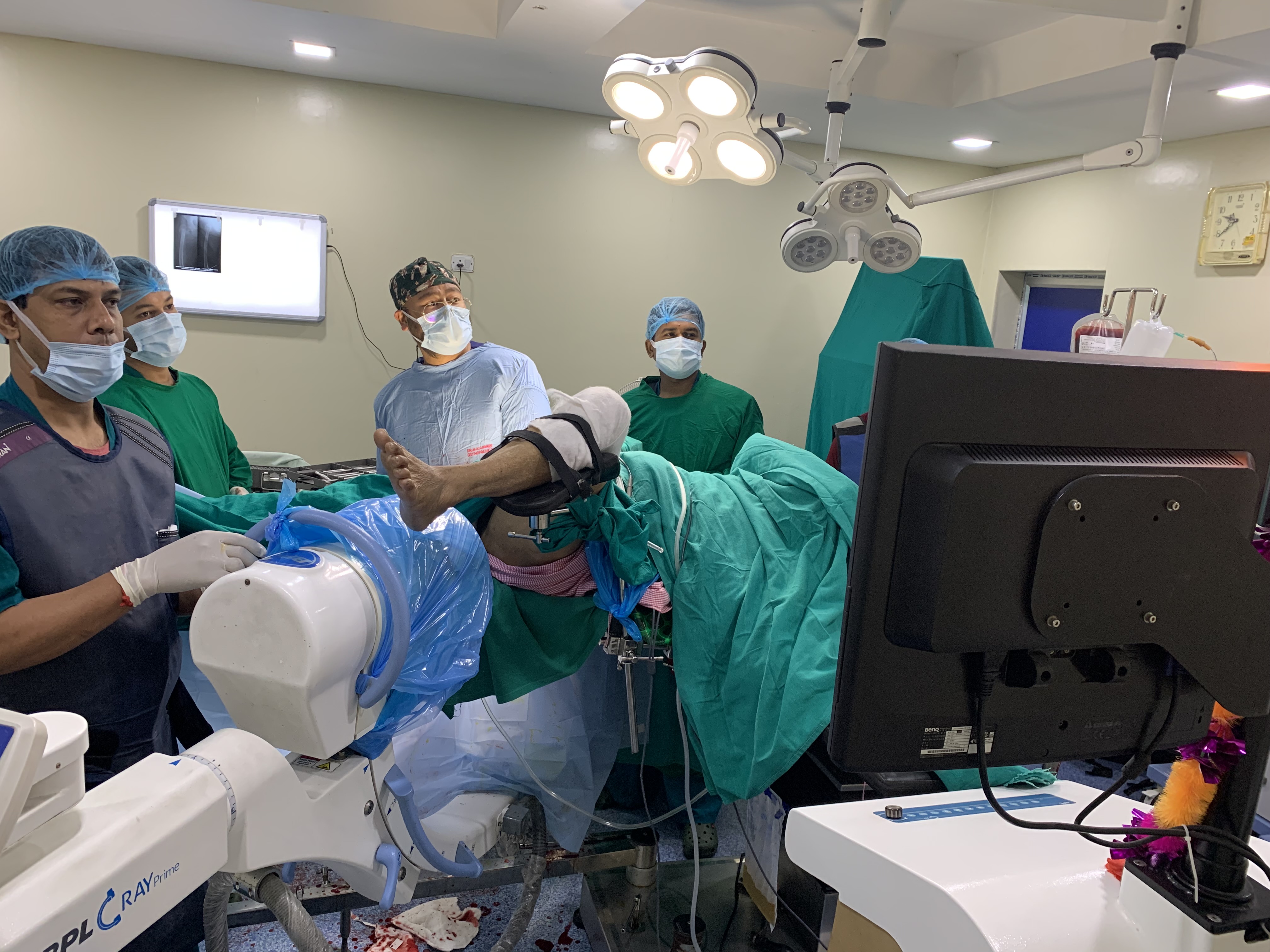 Intertrochanteric femur comminuted fracture treated by Closed Reduction & Internal Fixation with PFNA2 Titanium Interlocking Nail