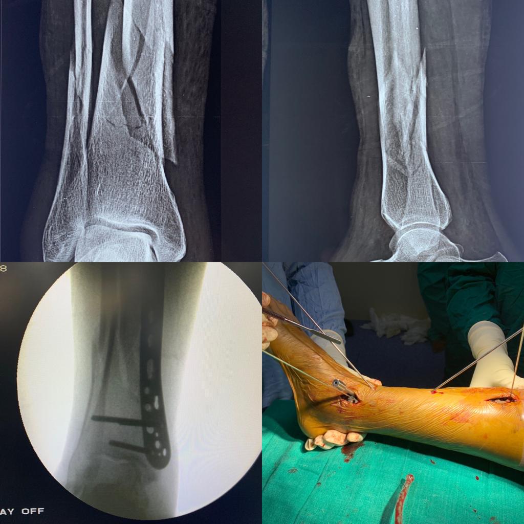 MIPPO in a distal one third tibia-fibula comminuted fracture in a patient of rheumatoid arthritis with osteoporosis with anaemia of chronic disease