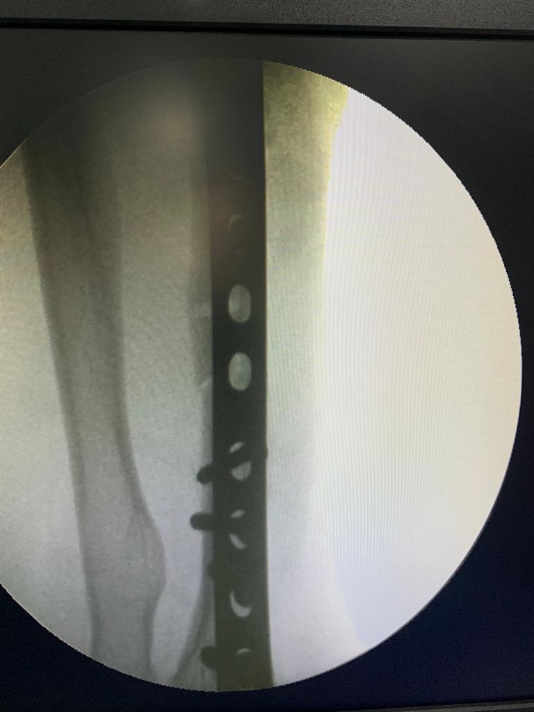 Left-sided Monteggia Fracture