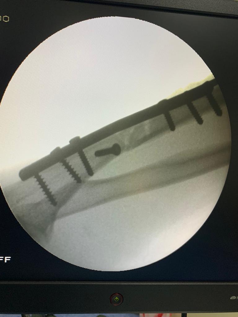 Left-sided Monteggia Fracture