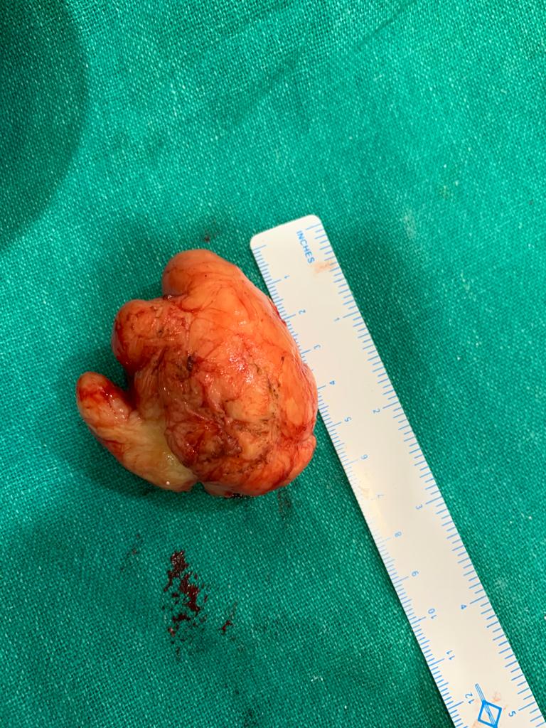 Wide Excision In Toto of a Fibroma