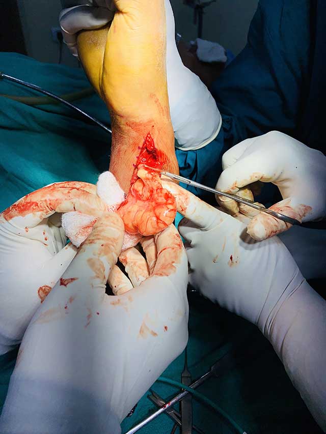 Wide Excision In Toto of a Fibroma