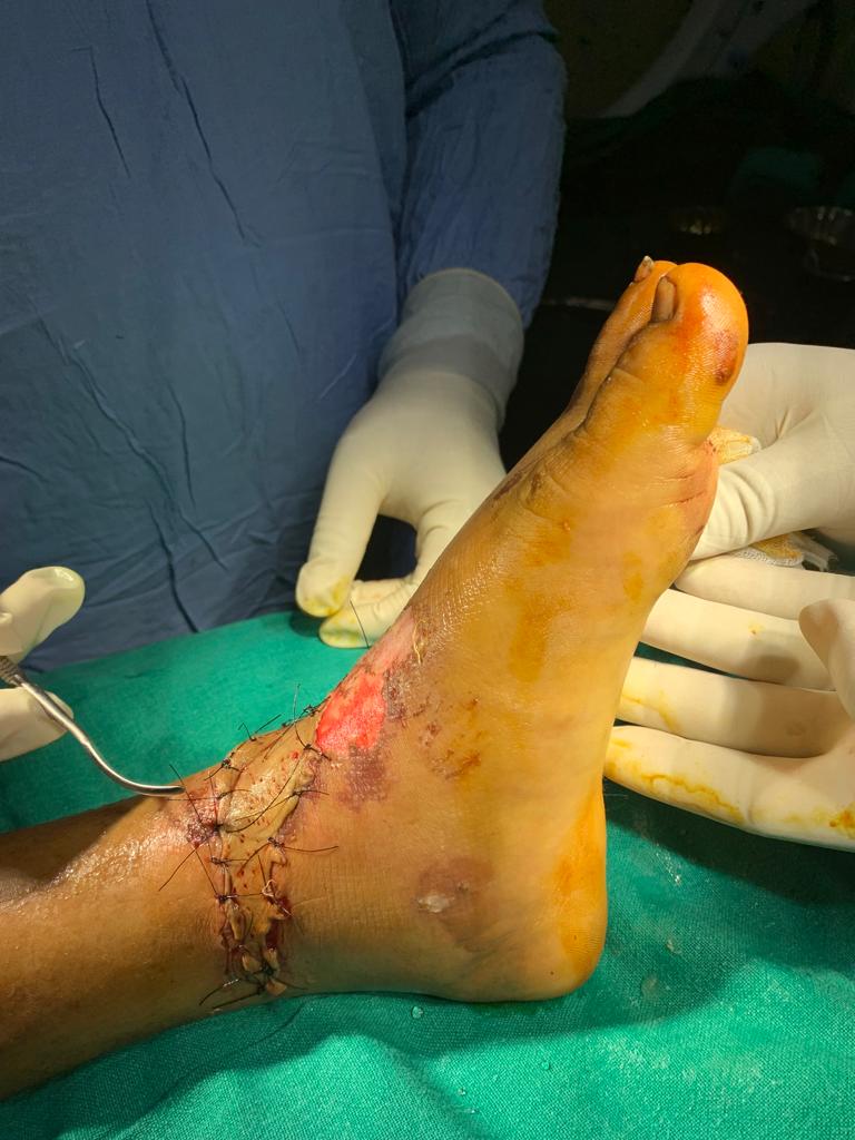Soft tissue reconstruction by Split Skin Grafting