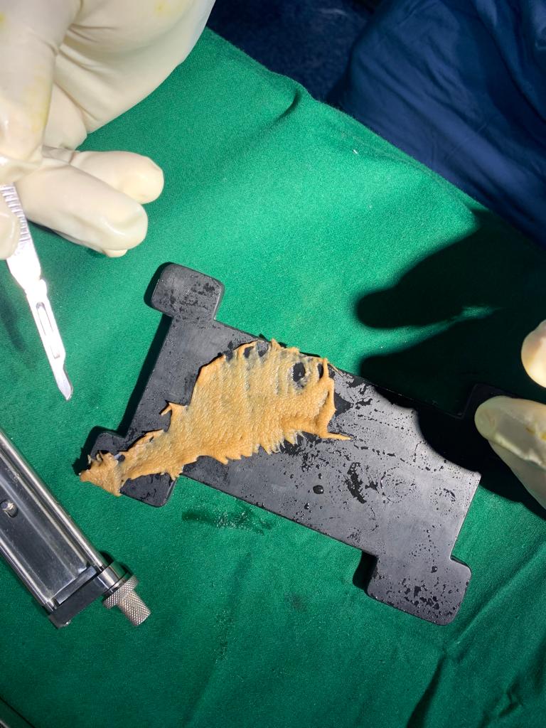 Soft tissue reconstruction by Split Skin Grafting