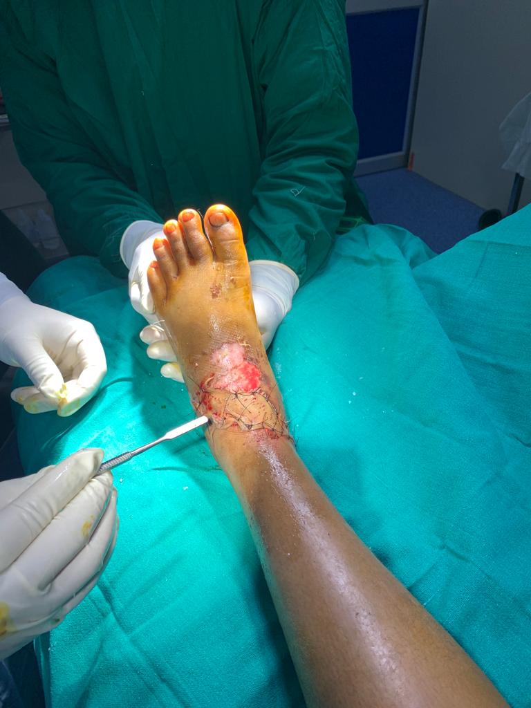 Soft tissue reconstruction by Split Skin Grafting